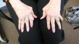 Rheumatoid,RA,nodules,damage