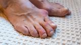gout,podagra,MTP
