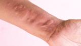 urticaria