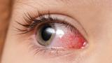 pediatric eye uveitis
