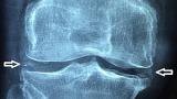Chondrocalcinosis