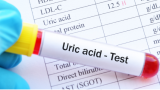 uric.acid.test
