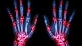 RA.Xray.Hands