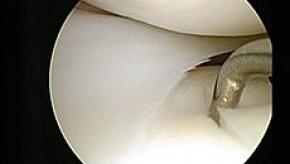 Arthroscopic%20Lateral_meniscus_damaged_tibial_cartilage.jpg