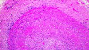 Giant_cell_temporal_arteritis.jpg
