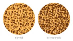OP.Osteoporosis.bone_.jpg