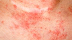 eczema-skin-on-neck.jpg
