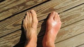 gout.feet_.jpg