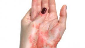 psoriasis-hand.jpg