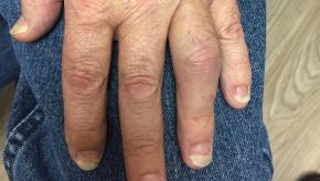 psoriatic.PIP_.JPG