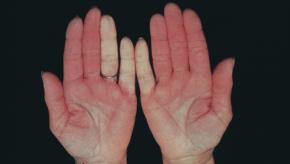 raynaud_0.jpg