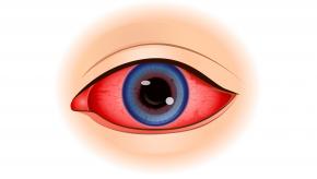 uveitis eye iritis