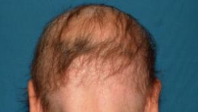 alopecia,areata,bald,hairloss