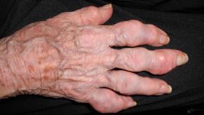 Gout,white,hand