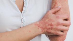 psoriasis,arm,hand,rash,elbow