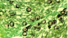 pneumocystis,PJP