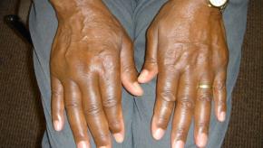 RA,polyarticular,black,rheumatoid