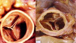 Aortic,stenosis,pathology