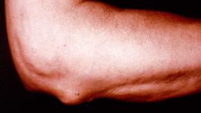 Rheumatoid,nodule