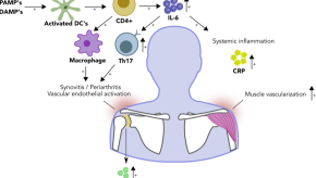 PMR,pathogenesis.JIM2022