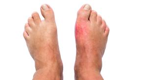 Gout,podagra,feet,292732063