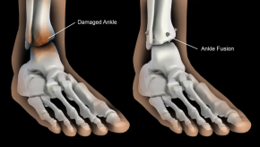 ankle.fusion.medpage