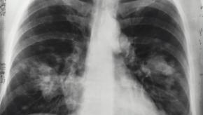Lung,cancer,nci