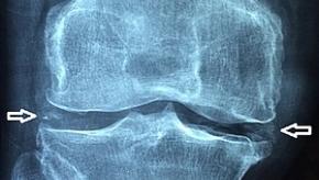 Chondrocalcinosis