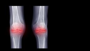KNee.calcinosis.inflammatin