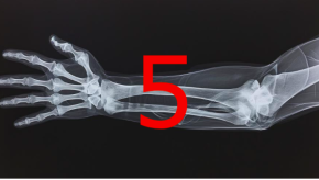 5 fractures