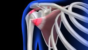 Rotator.Cuff.shoulder-pain