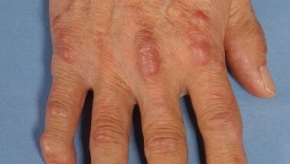 Multicentric reticulohistiocytosis