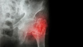 hip.fx.fracture