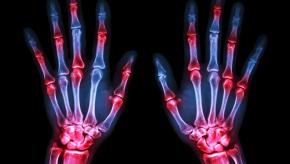 RA.Xray.Hands