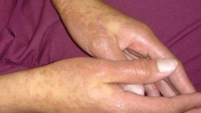 SLE.arthritis.rash.lupus