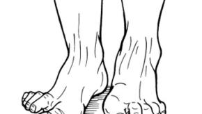 MTP.Hallux
