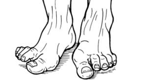 MTP.Hallux