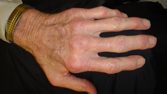 RA Hands Difficult deformity