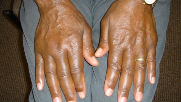 RA,polyarticular,black,rheumatoid