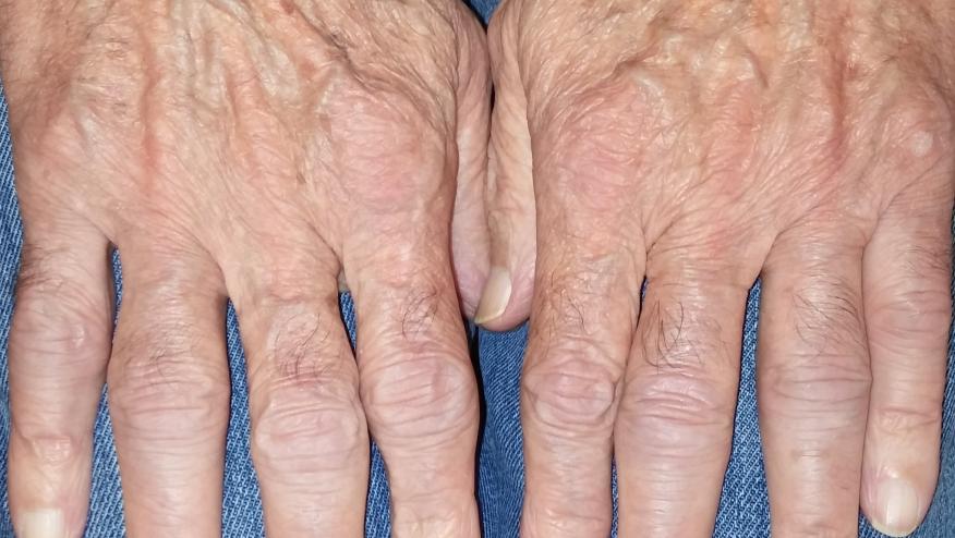 szeronegatív rheumatoid arthritis a lábujjak ízületeinek fájdalmai