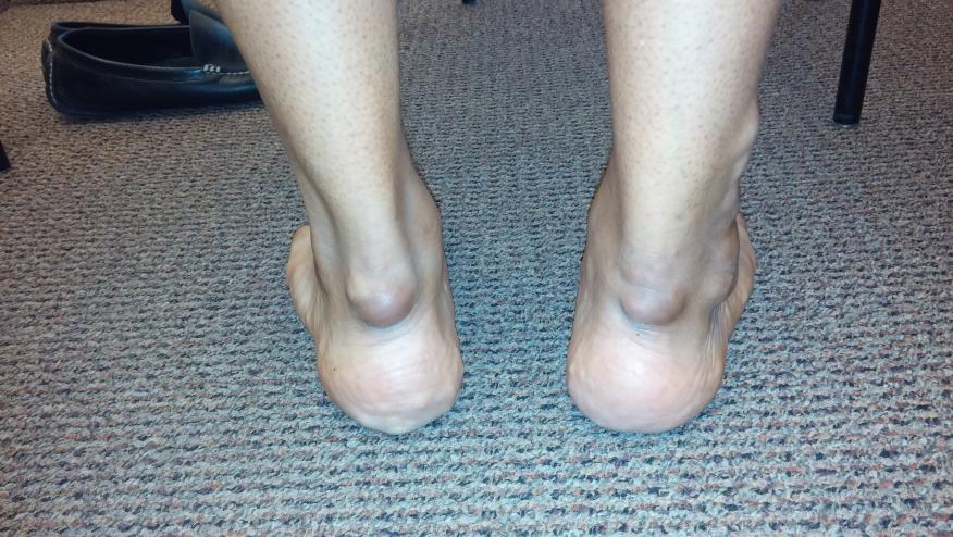 arthritis in heel of foot