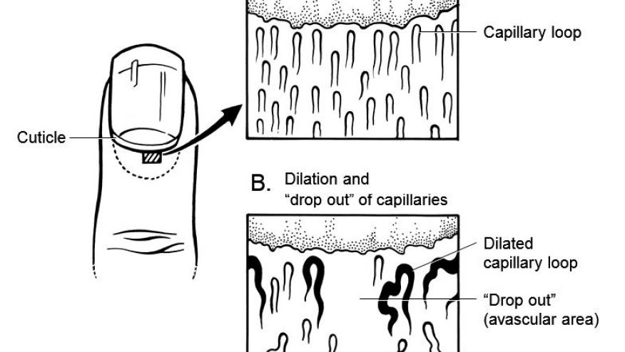 Nailfold Capillaroscopy in Pediatrics