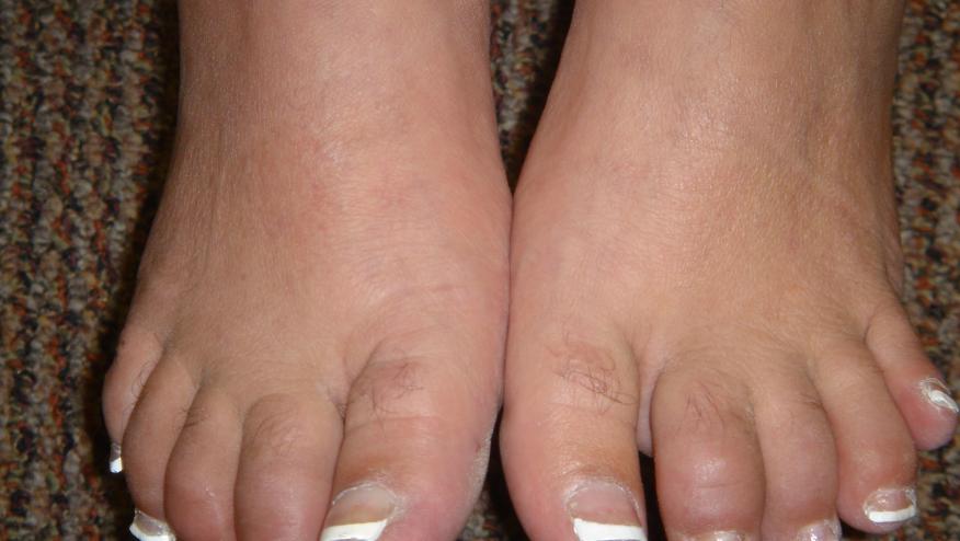psoriatic arthritis toes