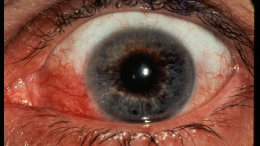 The Red Eye in the Rheumatology | RheumNow
