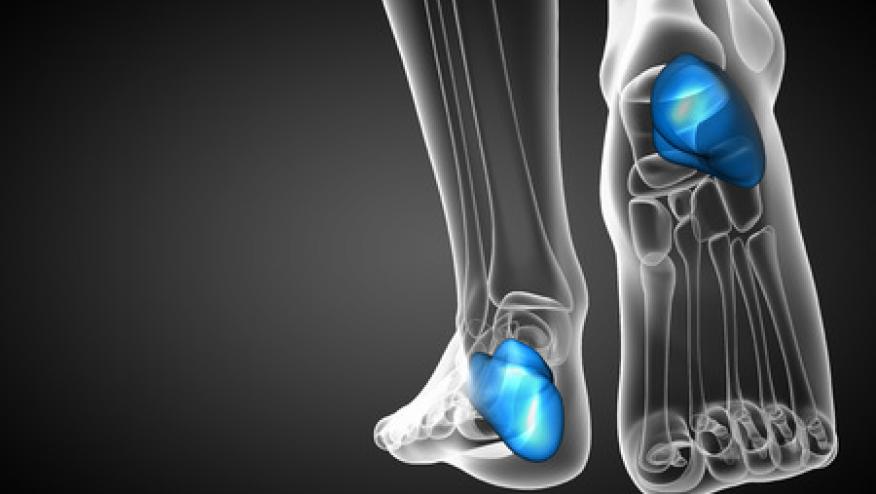 Shoe Inserts Disappoint With Plantar Heel Pain Rheumnow