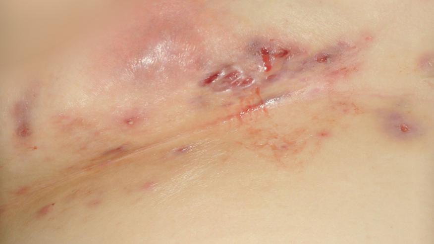 Chronic inflammatory nodules in the groin area