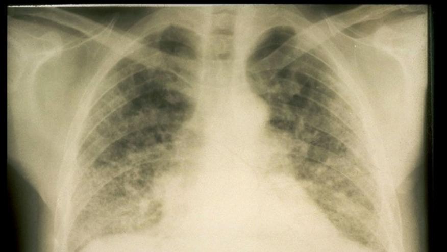 Slow Lung Decline Typical in Systemic Sclerosis | RheumNow