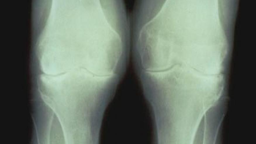 osteoarthritis knee mri