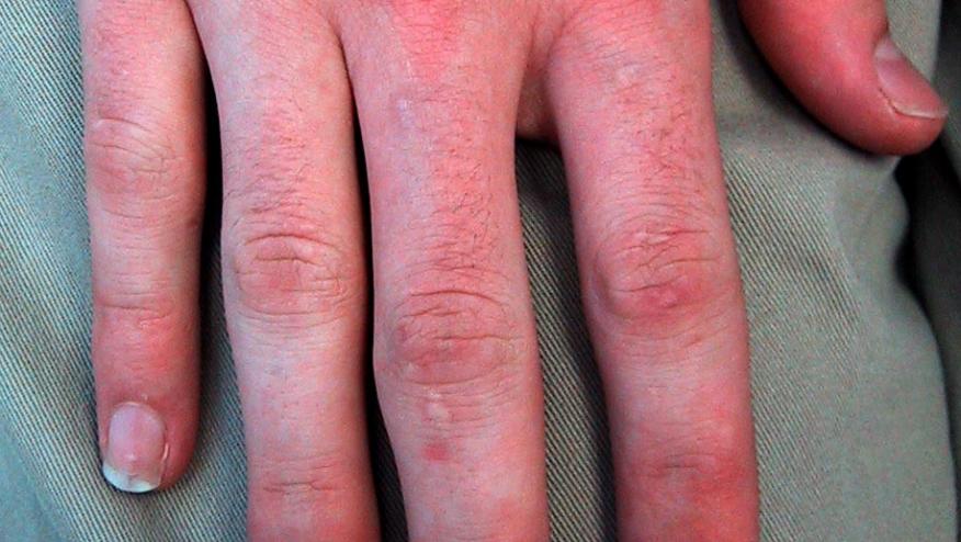 mild psoriasis on hands