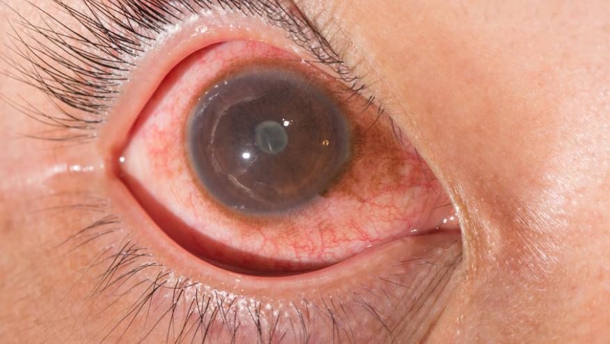 juvenile idiopathic arthritis with uveitis